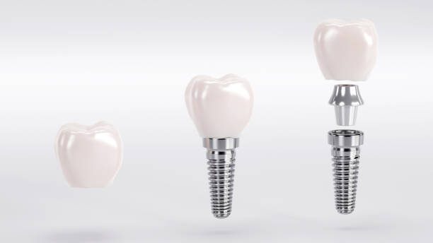 Why Dental Implants are Made of Titanium