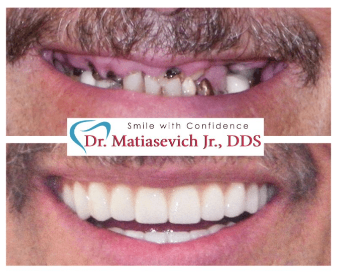 Before and after Dental Treatment in Santa Cruz Family Dentist