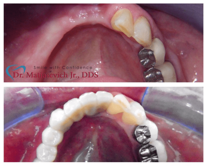 Before and after Dental Treatment in Santa Cruz Family Dentist
